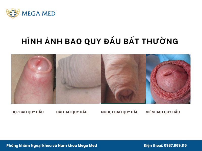 Hình ảnh bao quy đầu bất thường